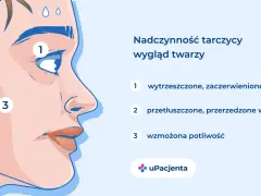 Nadczynność tarczycy objawy: wytrzeszczone oczy (1), przetłuszczone włosy (2) i wzmożona potliwość (3) na twarzy.