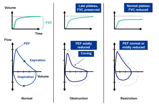 Wykresy spirometrii porównujące normy z obturacją i restrykcją. Pokazują różnice w przepływie i objętości.
