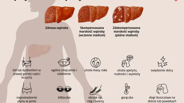 Ilustracja przedstawia objawy marskości wątroby, od zdrowej do zaawansowanej. Wskazuje na bóle brzucha, zmęczenie, utratę masy ciała, żółtaczkę, obrzęki, gorączkę i zmiany skórne. Leczenie marskości wątroby zależy od stadium.