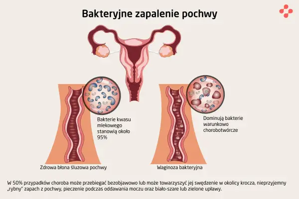 Ilustracja porównuje zdrową pochwę z dominującymi bakteriami kwasu mlekowego do waginozy bakteryjnej, gdzie przeważają bakterie chorobotwórcze.